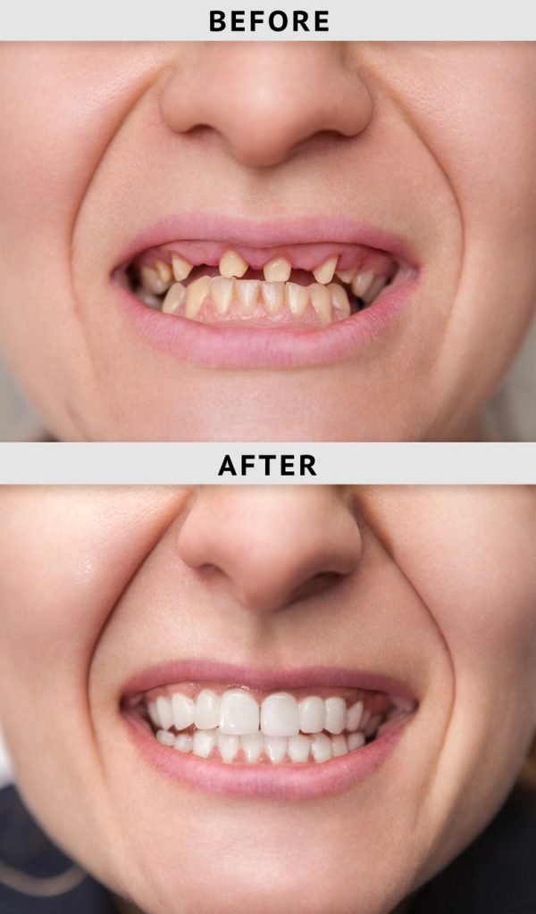 Before & After Dental Implants